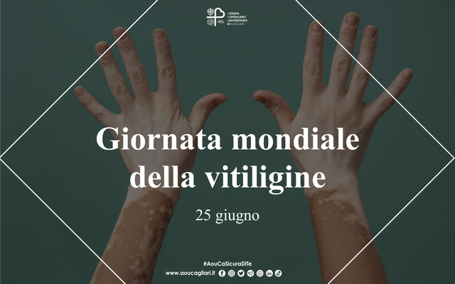Vitiligine, in tutto il mondo 330 mila persone colpite