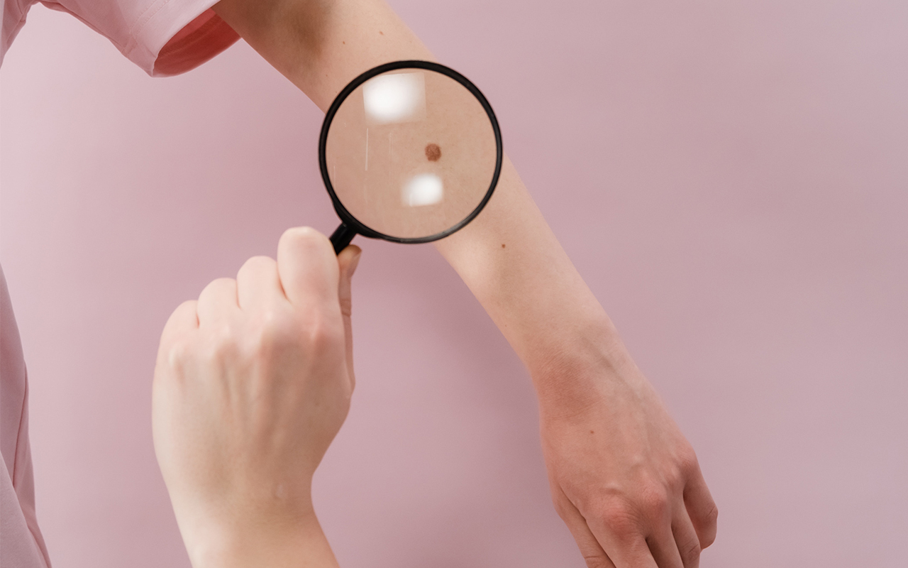 Foto melanoma