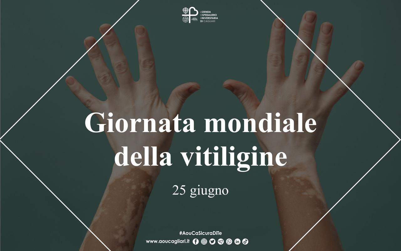 Vitiligine, in tutto il mondo 330 mila persone colpite